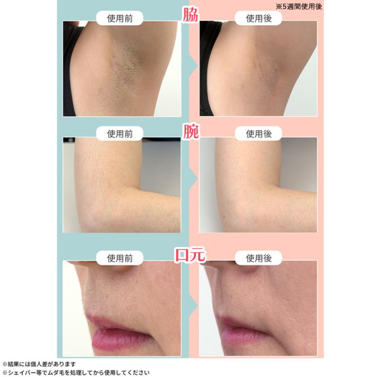 CQ クリニカルエピ ClinicalEpi Professional 脱毛器