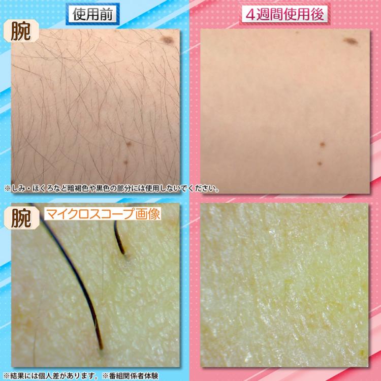 今 お得！】ReFa EPI GO(リファ エピ ゴー)／光美容器／ムダ毛ケア