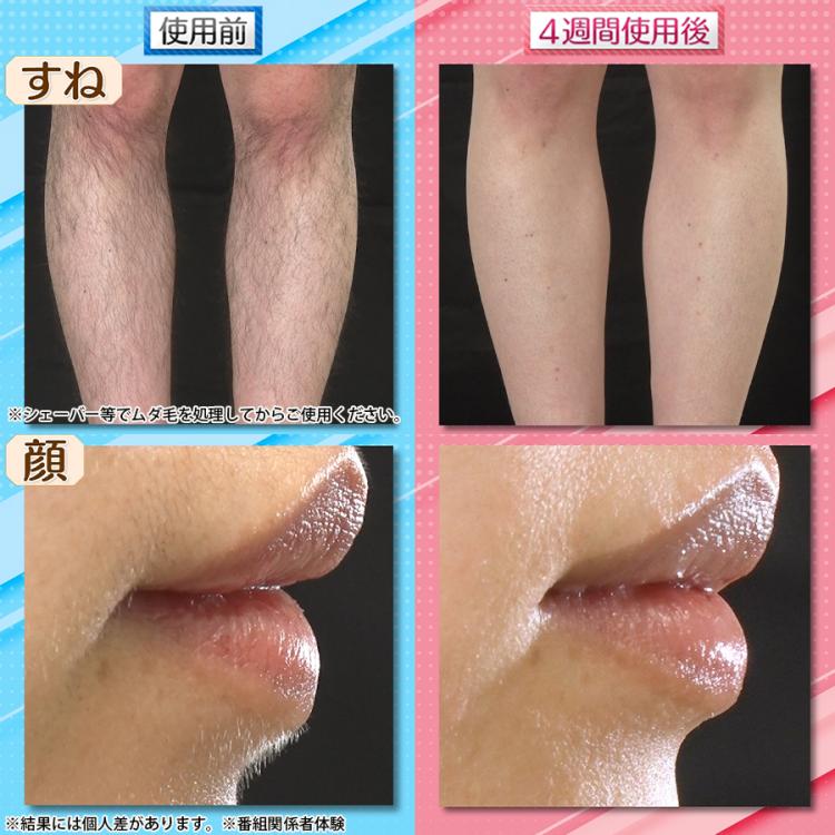 今 お得！】ReFa EPI GO(リファ エピ ゴー)／光美容器／ムダ毛ケア