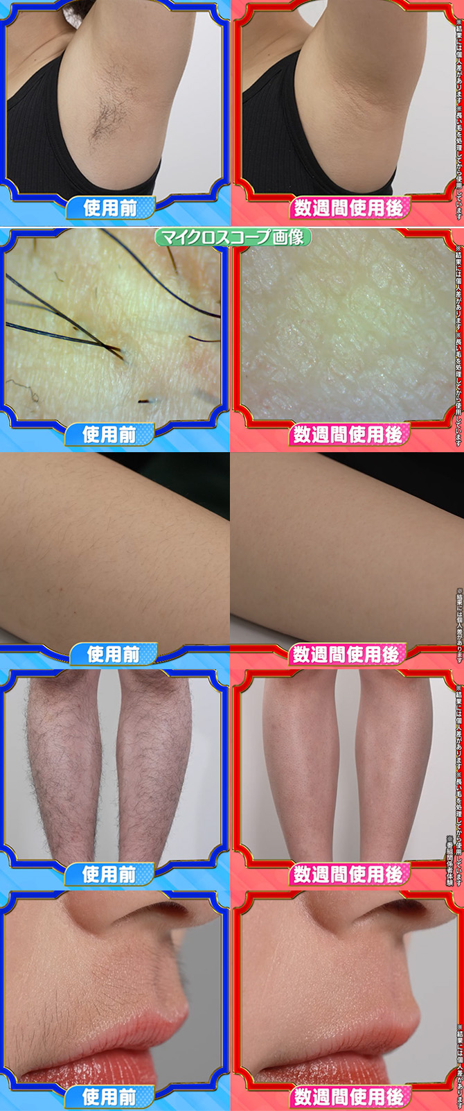 家庭用としてはシリーズ最高レベル(※1)の照射パワー
男性の濃いヒゲやスネ毛もしっかりケア！