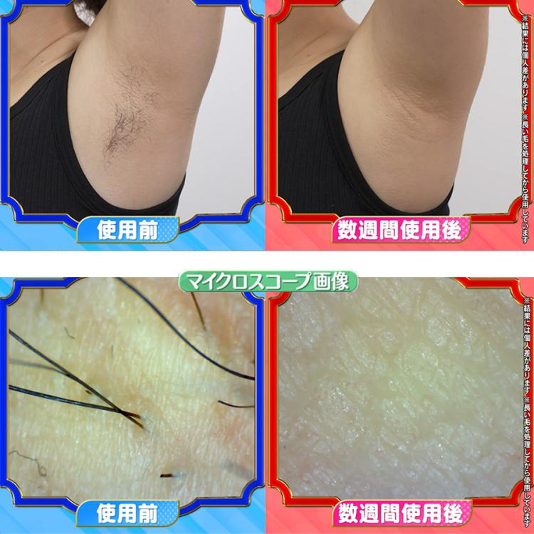 STELLA BEAUTE(ステラボーテ) IPL光美容器 Luna(ルナ)／フラッシュ式