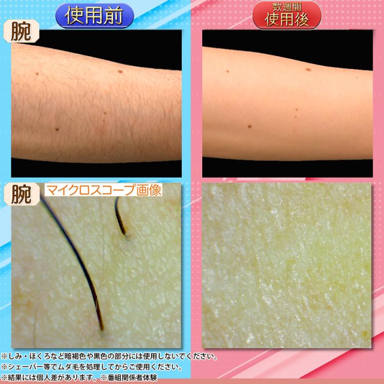 今お得！】リファ エピ ゴー（ReFa EPI GO）／光美容器／ムダ毛ケア