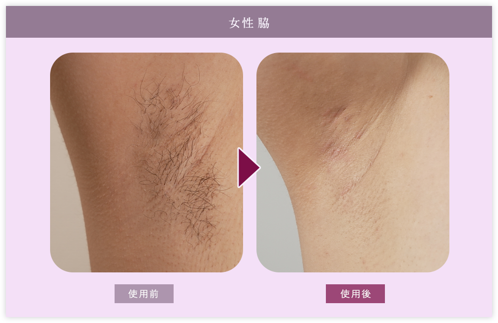 女性脇