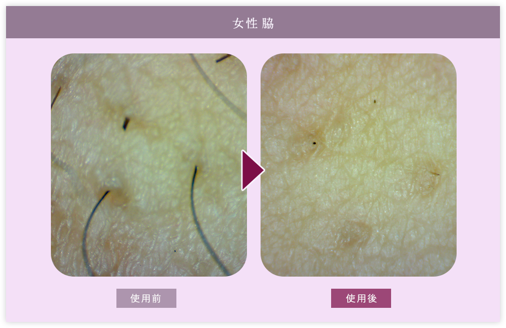 女性脇 皮膚層