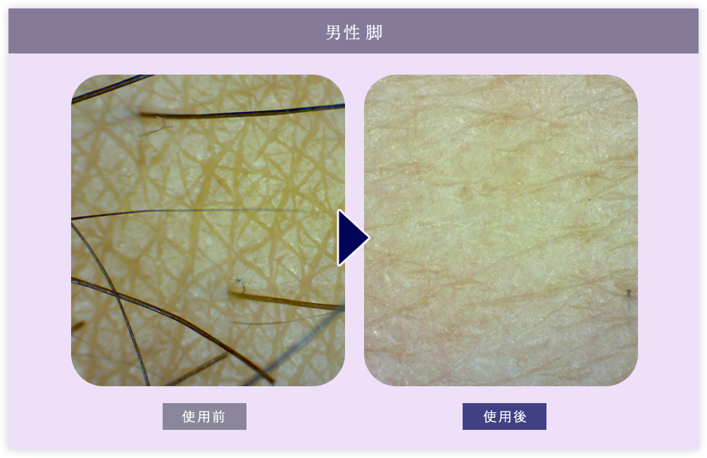 男性脚 皮膚層
