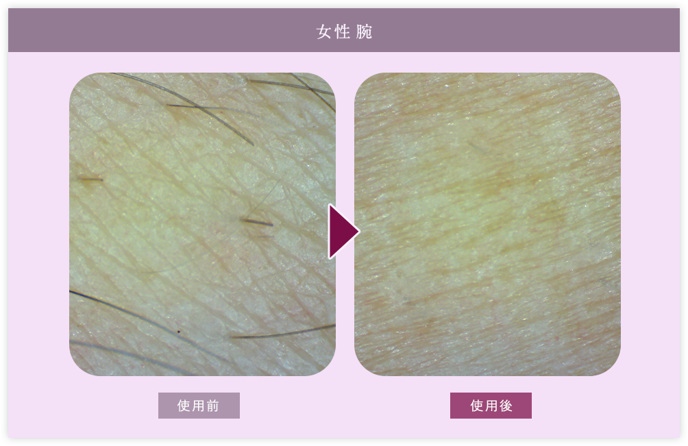 女性腕 皮膚層